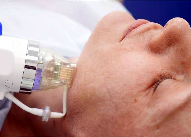 RF microneedling technology at a Blackburn skin clinic